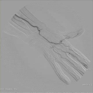 Case modelling of ulnar artery occlusion with active blood flow in ...