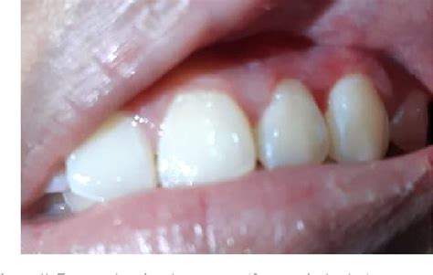 Figure 1 From Management Of Fibrous Epulis Of Anterior Maxillary Teeth