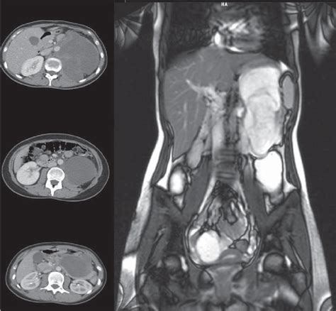 abdominal computed tomography showing  large soft tissue mass