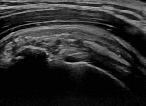 Musculoskeletal Joints and Tendons | 6.1 Shoulder : Case 6.1.18 Bursa ...