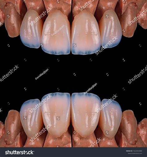 4 Units Dental Veneers Stock Photo 1022054488 Shutterstock