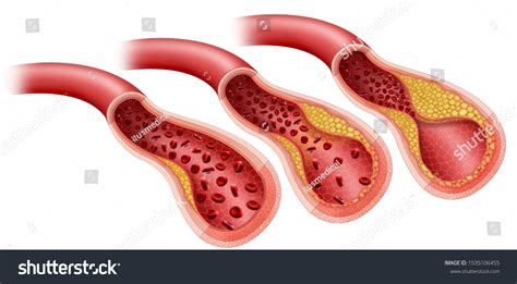 1,134 Arterial Blockage Images, Stock Photos & Vectors | Shutterstock