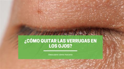 ¿cómo Quitar Las Verrugas En Los Ojos Clinicaortunoes