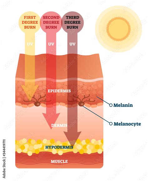 Sunburn Skin Damage Anatomical Cross Section Diagram Stock Vector