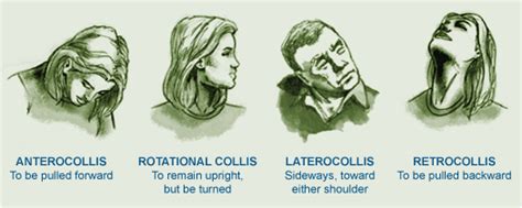 Wry Neck Torticollis Causes Types And Symptoms