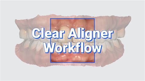 Clear Aligner Workflow Youtube