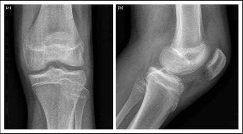 Tibial Spine Avulsion Fractures Treatment Update Semantic Scholar