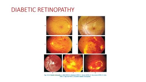 Diabetic Retinopathy Grading