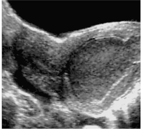 Didelphys Uterus Ultrasound