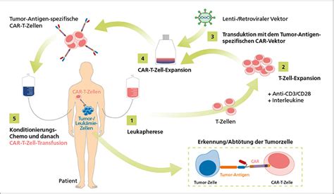 Therapie Von Lymphom Und Leuk Mie Patienten Mittels Car T Zellen Seite