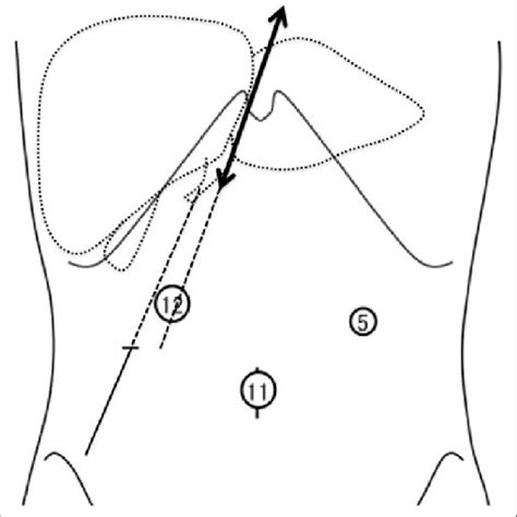 Schema For Operating Procedure After Trocar Placement And Liver