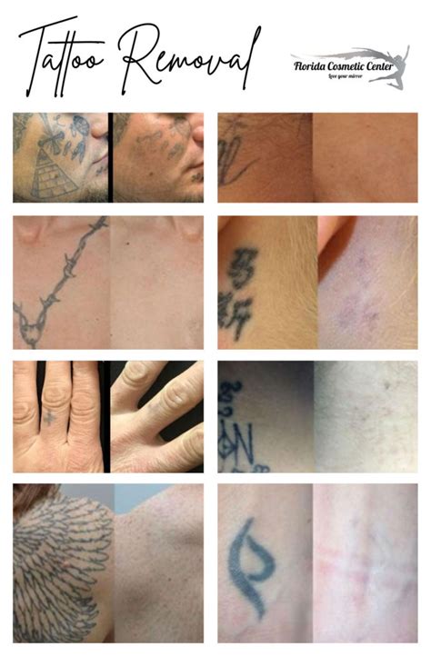 Laser Tattoo Removal Florida Cosmetic Center