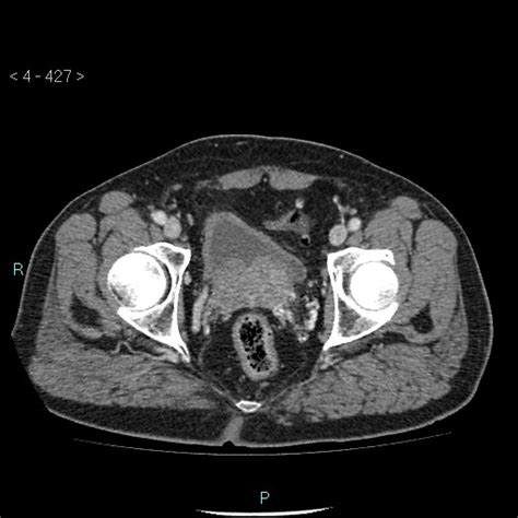 Radiopaedia Case Urinary Bladder Hernia Id Study Nc Commons