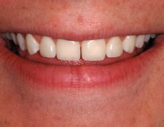 Before And After Blair Ridge Dental Hiawatha IA