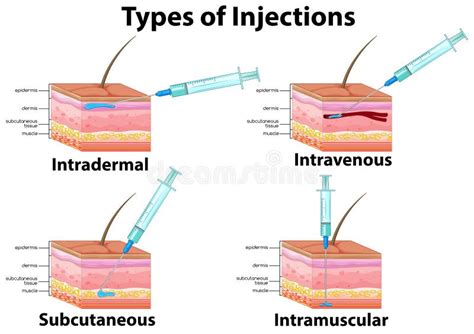 Intradermal Subcutaneous Injection Stock Illustrations 23 Intradermal