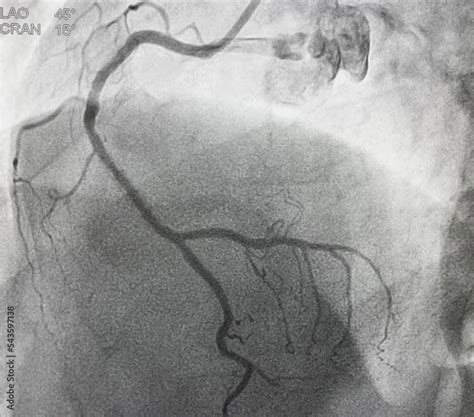 Coronary angiogram (CAG) of right coronary artery (RCA). Stock Photo ...