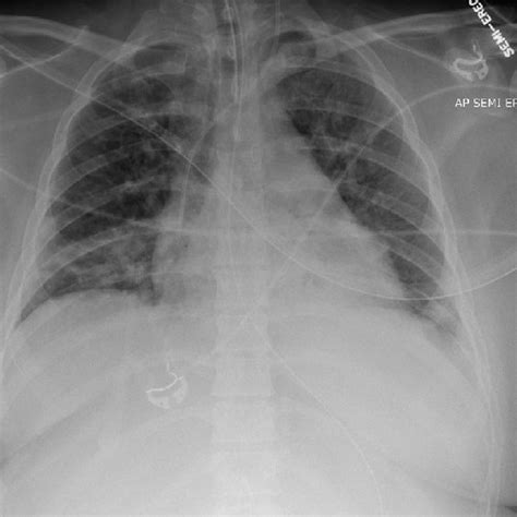 Figure Chest Radiograph Obtained With Portable Machine Of