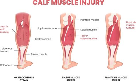 calf muscle injury infographic 21432411 Vector Art at Vecteezy