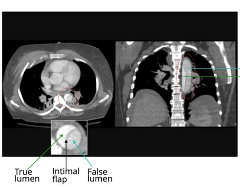 Clinical Pathology Glossary Aortic Aneurysm And Dissection Ditki Medical And Biological Sciences