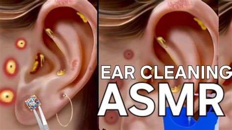 Ear Cleaning Asmr Ear Wax Removal Pimple Popping Youtube