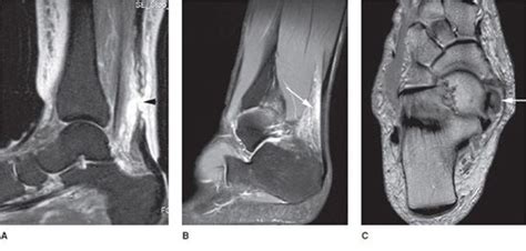 Ankle Mri Radiology Key