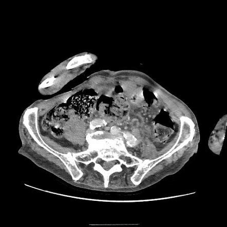 Faecal Impaction With Stercoral Colitis Radiology Case Radiopaedia Org