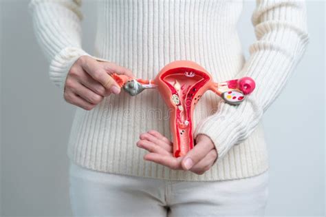 Donna Con Utero E Ovaie Tumore Ovarico E Cervicale Disordine