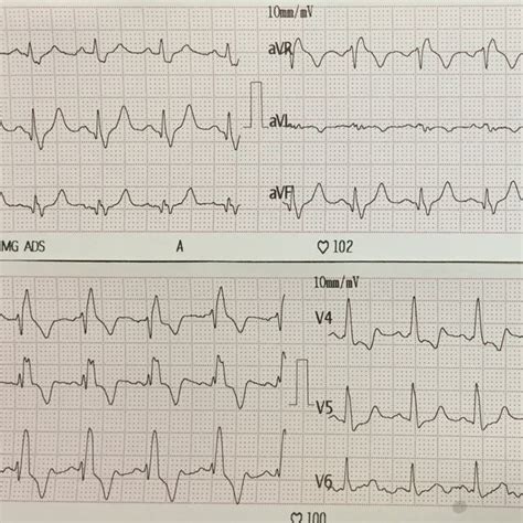 Electrocardiography Shows Right Bundle Branch Block Download