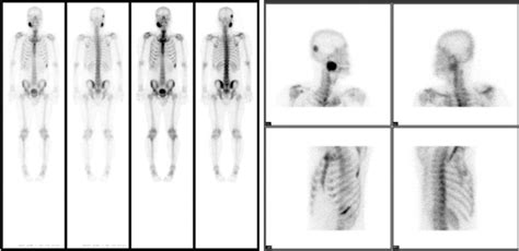 Tc M Mdp Bone Scan Increased Tracer Uptake In The Mandible Right