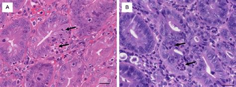 inflamed crypts   colon mucosa representative images