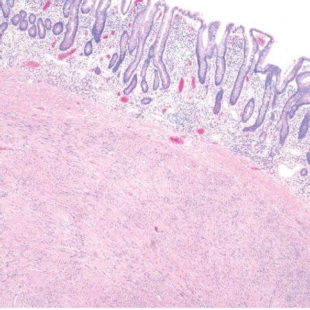 Histology slides from the specimen documenting: (a) small bowel with a ...