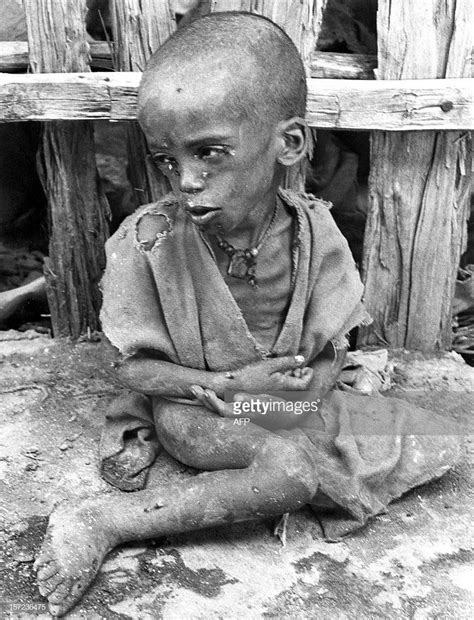 Picture Of A Child Suffering For Starvation And Malnutrition On