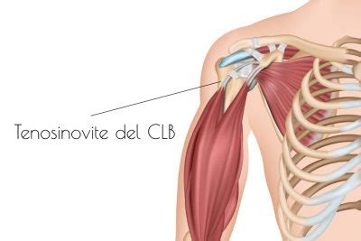 La tenosinovite del CLB di spalla cosè e come si cura Centro Salute