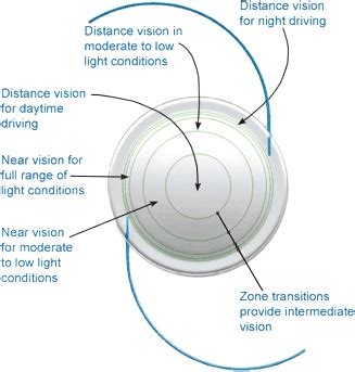 Multifocal Lens Implants and Cataracts at NeoVision in Union City