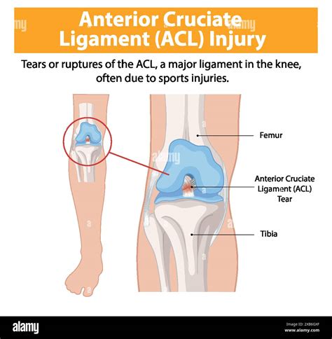 Illustration Of Acl Tear In The Knee Stock Vector Image And Art Alamy