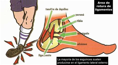 Esguince De Tobillo Cadena Lesional Visi N Osteop Tica