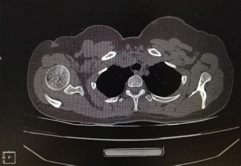 Showing Ct Scan Axial View At T1 Level Showing T1 Spina Bifida