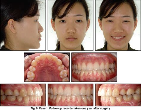 Treatment Of Class III Relapse Due To Late Mandibular Growth Using