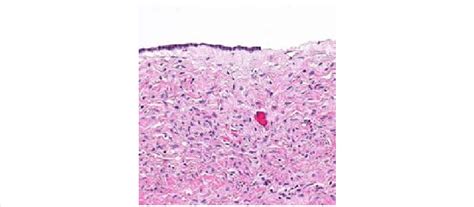 Serous Cystadenoma and histology of the tumor showing the cystic space ...