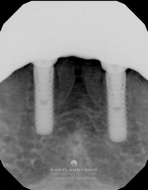 Lower All On Zirconia Implant Tami Portland Perio Implant Center