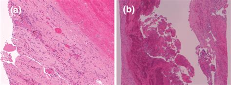 Clinmed International Library Symptomatic Yuxta Articular Facet Cyst