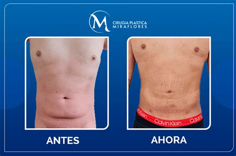 Lipoescultura Masculina Cpm