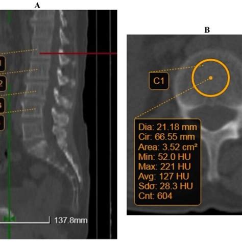 Example Of Quantitative Computed Tomography Qct Measurement A