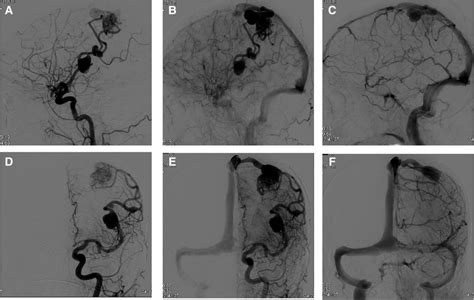 Early Middle And Late Phases Of Dsa Ac Sagittal Lateral And