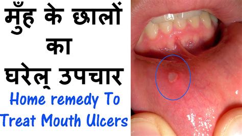 Home Remedy To Treat Mouth Ulcers In Hindi Youtube