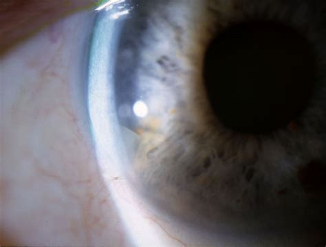 Anterior Uveitis Slit Lamp