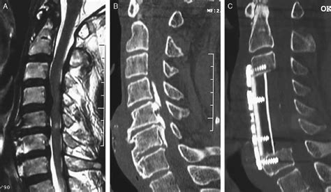 A-C, Representative radiographs of the corpectomy group. The corpectomy ...