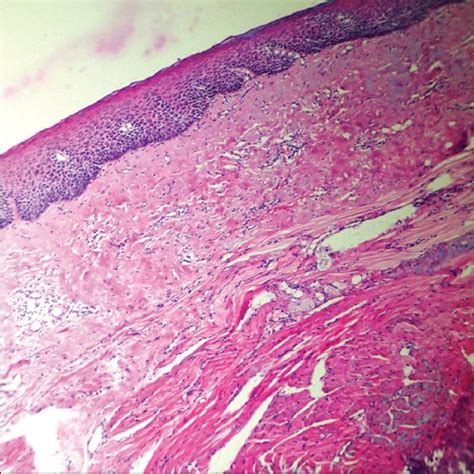 Oral Submucous Fibrosis Histopathology