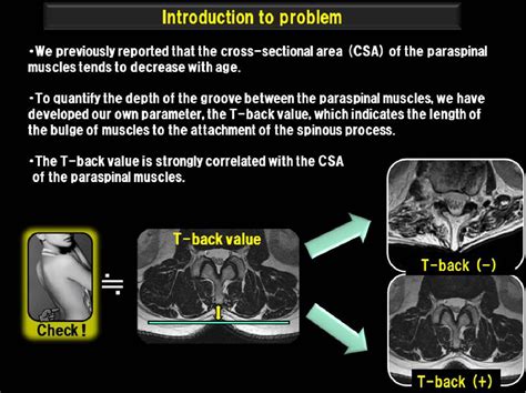 Figure 1 From Comparison Of MRI Features Of Psoas Muscles In Patients