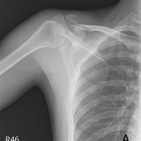 A. 20-year-old female with distal clavicular fracture. Zanca view... | Download Scientific Diagram